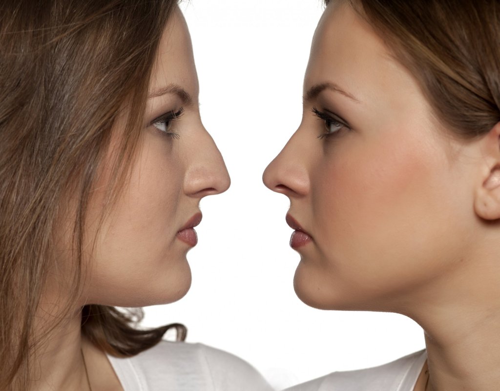 Woman's face before and after rhinoplasty