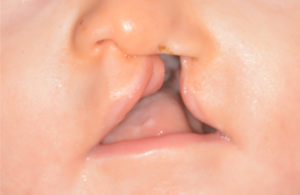 Baby with a cleft lip